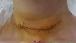 我市首例甲状腺腺瘤腔镜切除术在我院成功开展告别了脖子上开刀留下的“自杀”式疤痕