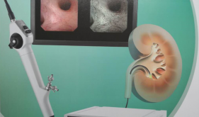 科室品牌与特色：泌尿系结石的微创治疗—输尿管软镜技术