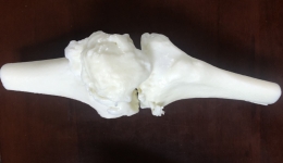 3D打印技术重塑患者“膝”望七旬老人感慨太神奇 ——我院成功完成一例3D打印复杂膝关节置换手术