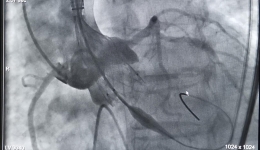 七旬老人“主动脉狭窄”+“胆结石”，TAVR微创手术解决患者心功能“大难题”