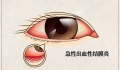 健康提醒 ： 近期“红眼病”高发，如何预防是关键