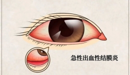 健康提醒 ： 近期“红眼病”高发，如何预防是关键