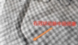 【卓越医疗在湖一】 35岁青年男子确诊急性心梗！年轻人更需警惕心梗