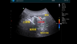 【卓越医疗在湖一】 湖医附一医院成功开展怀化首例床旁肌骨超声引导治疗三叉神经痛